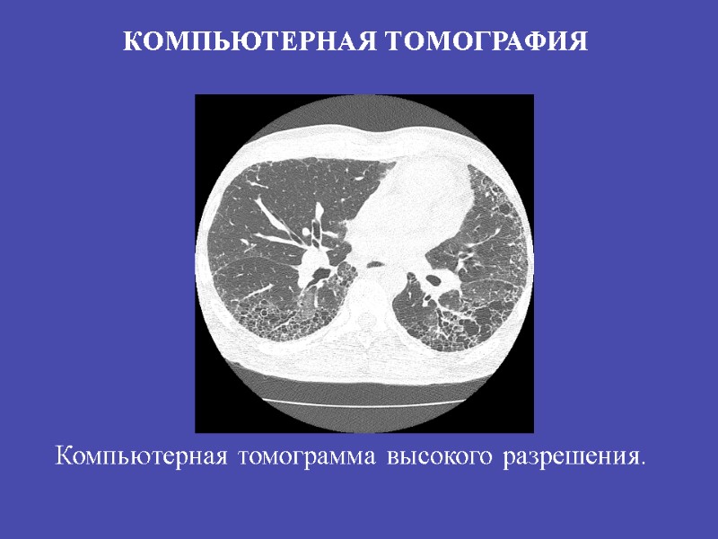 КОМПЬЮТЕРНАЯ ТОМОГРАФИЯ Компьютерная томограмма высокого разрешения.